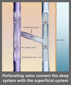 superficial and perforating veins of the lower limb cum sa reproducei o oet de mere cu varicoza
